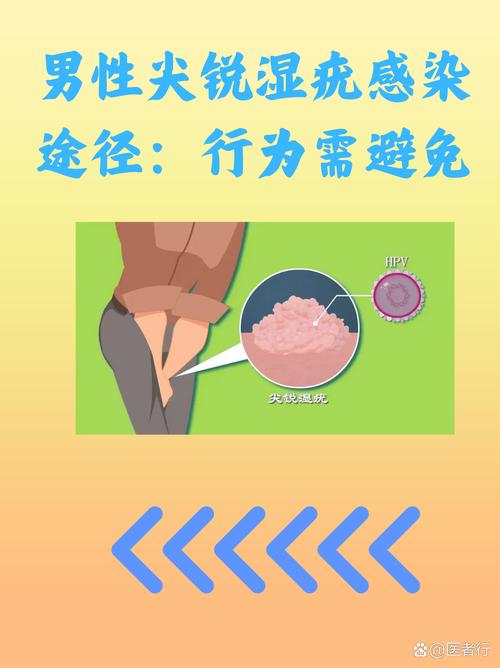 揪出尖锐湿疣病因！这3个感染途径很多人还在做