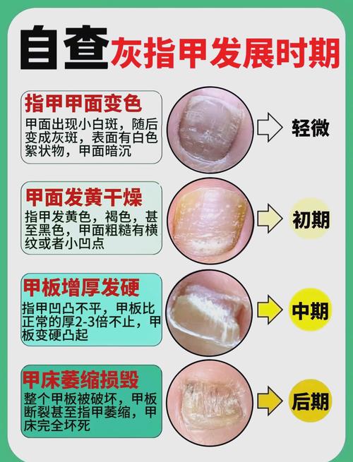 灰指甲危害不容小觑！轻松几步教你摆脱尴尬，重获健康美甲