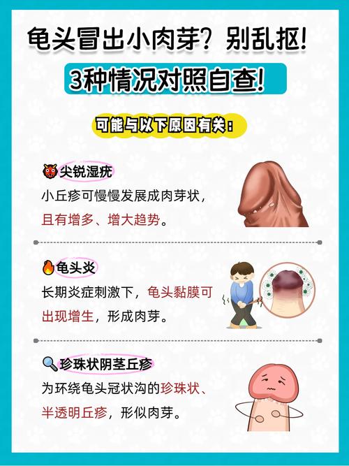 包皮尖锐湿疣别慌张！轻松读懂防治要点，守护健康其实很简单