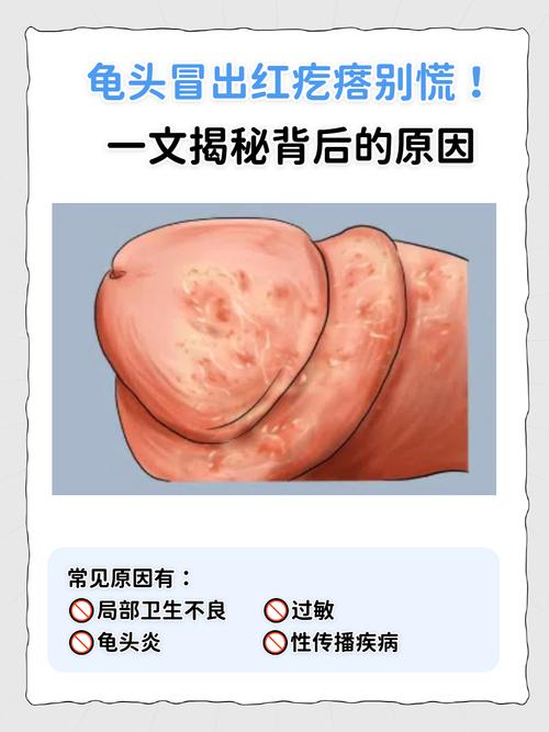 包皮过长有哪些症状?别害羞,这5个信号提醒你该注意了!