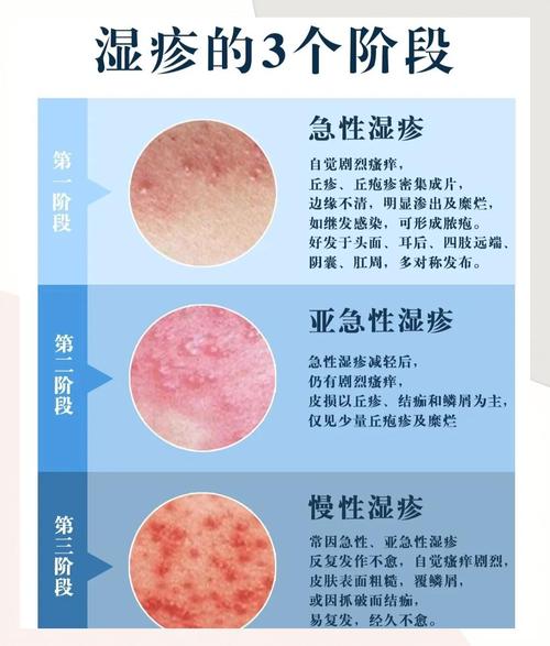 湿疹是什么原因引起的?轻松搞懂皮肤闹脾气的真相!